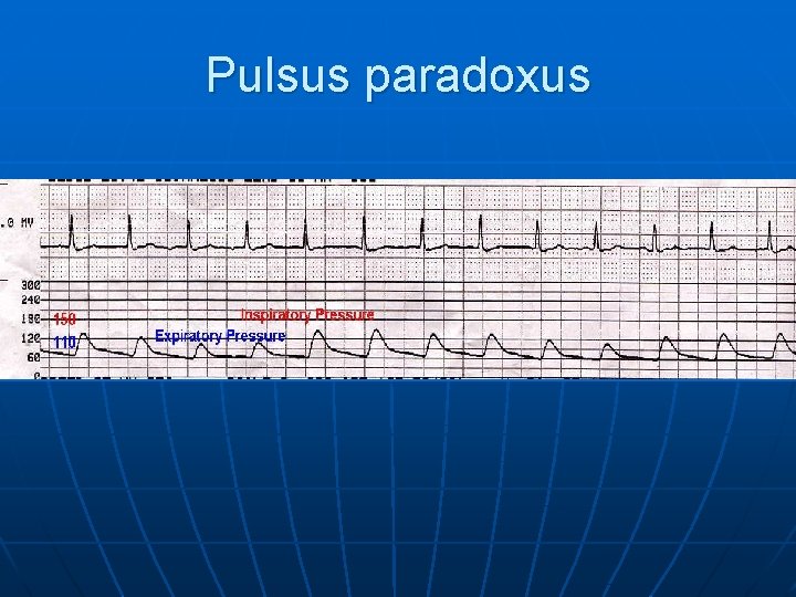 Pulsus paradoxus 