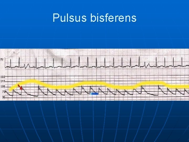 Pulsus bisferens 
