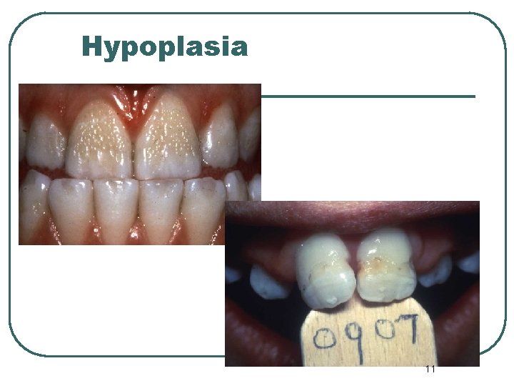 Hypoplasia 11 
