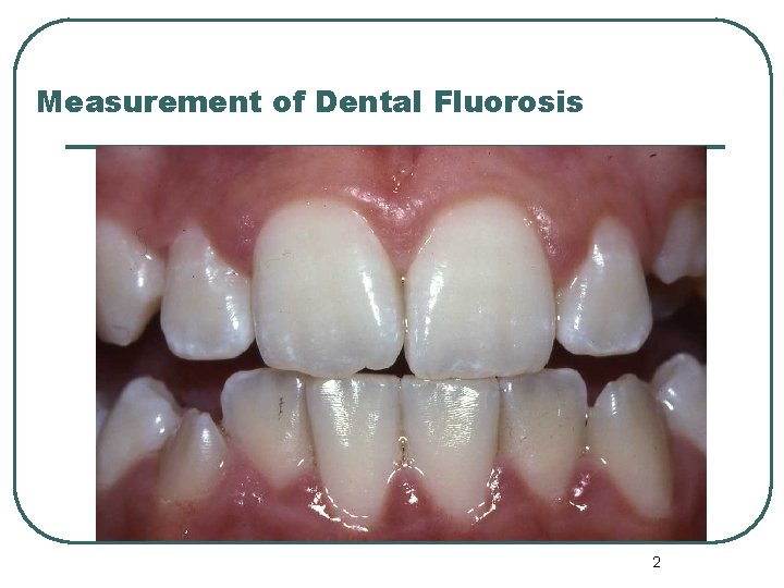 Measurement of Dental Fluorosis 2 