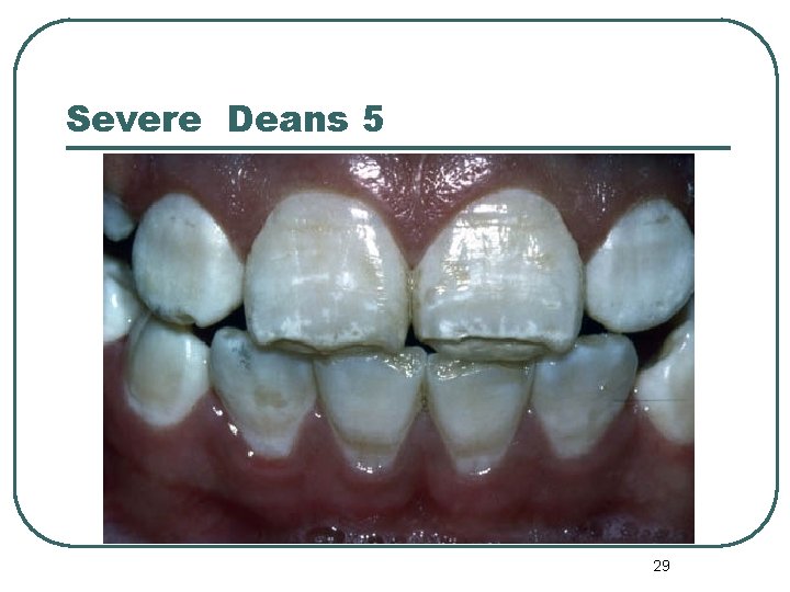 Severe Deans 5 29 