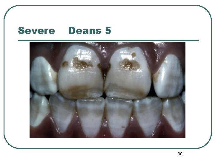 Severe Deans 5 30 