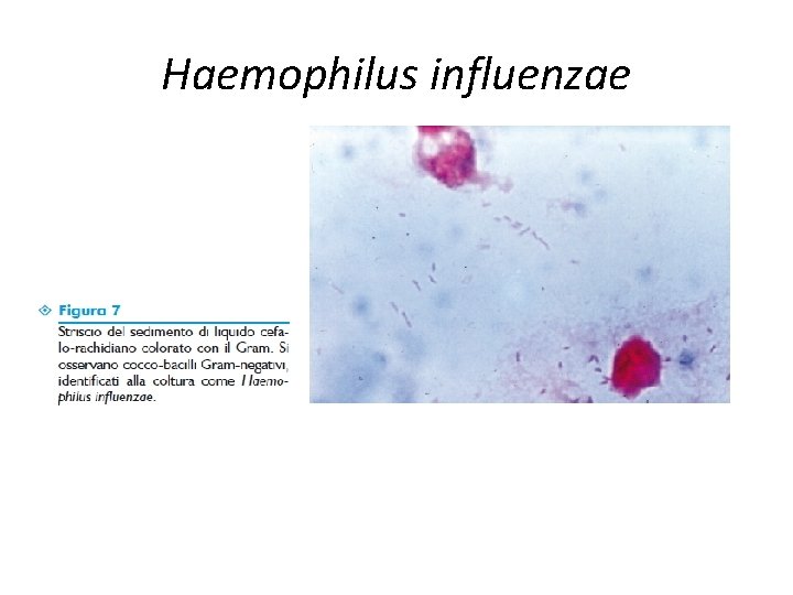 Haemophilus influenzae 