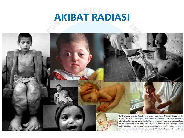 AKIBAT RADIASI 