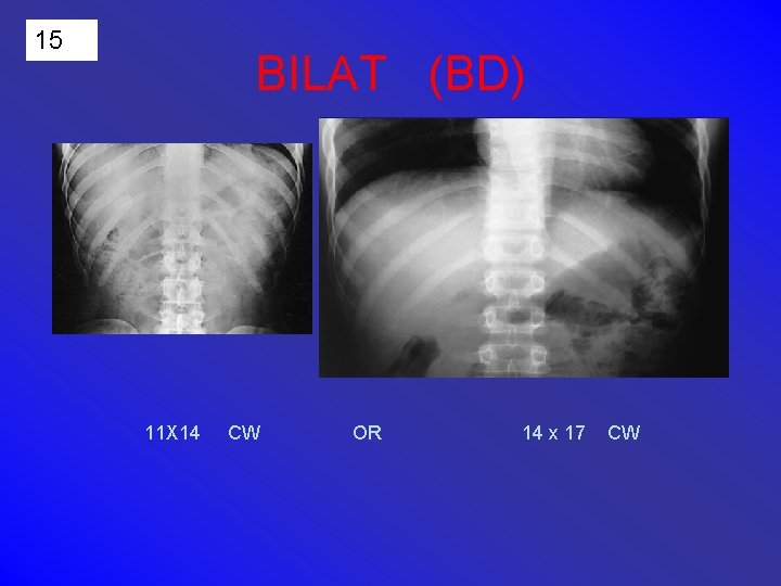 15 BILAT (BD) 11 X 14 CW OR 14 x 17 CW 