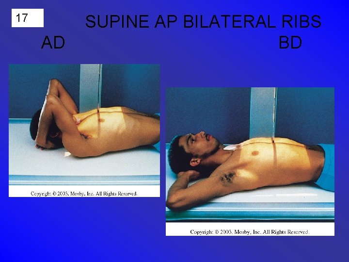 17 AD SUPINE AP BILATERAL RIBS BD 