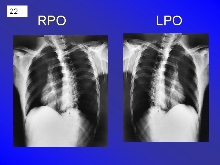 22 RPO LPO 