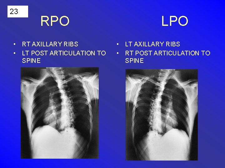 23 RPO • RT AXILLARY RIBS • LT POST ARTICULATION TO SPINE LPO •