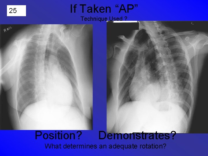 25 If Taken “AP” Technique Used ? Position? Demonstrates? What determines an adequate rotation?