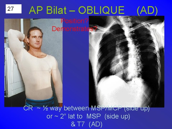 27 AP Bilat – OBLIQUE (AD) Position? Demonstrates? CR ~ ½ way between MSP/MCP