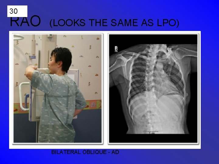 30 RAO (LOOKS THE SAME AS LPO) BILATERAL OBLIQUE - AD 