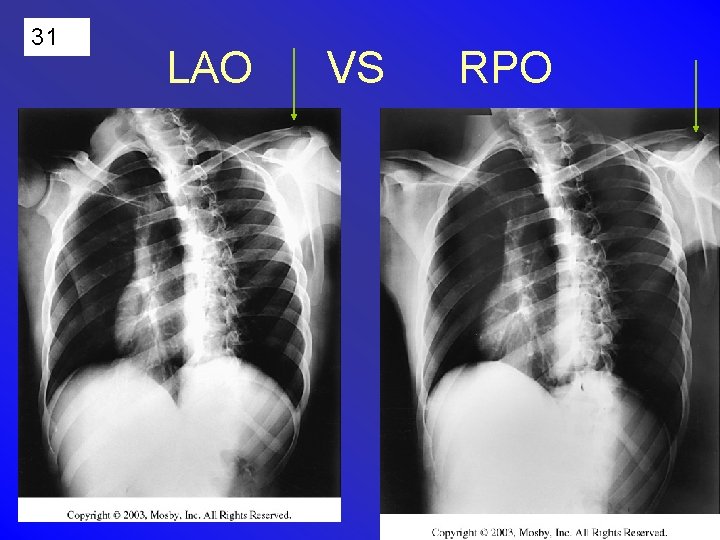 31 LAO VS RPO 