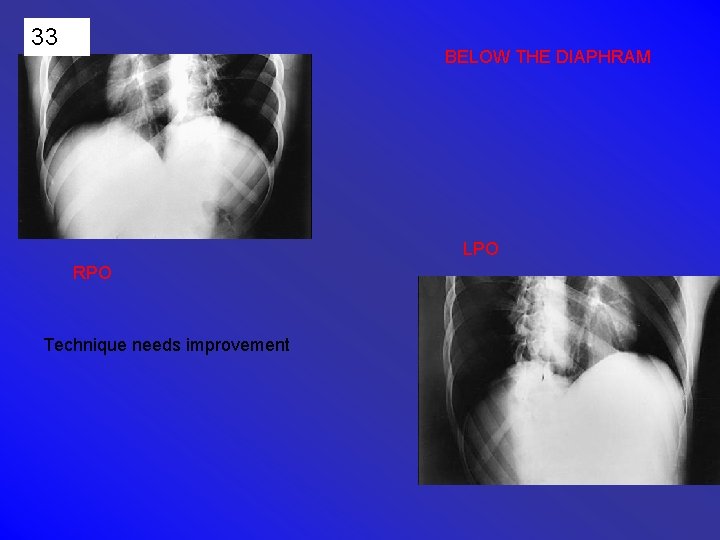 33 BELOW THE DIAPHRAM LPO RPO Technique needs improvement 