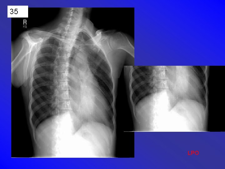 35 LPO 