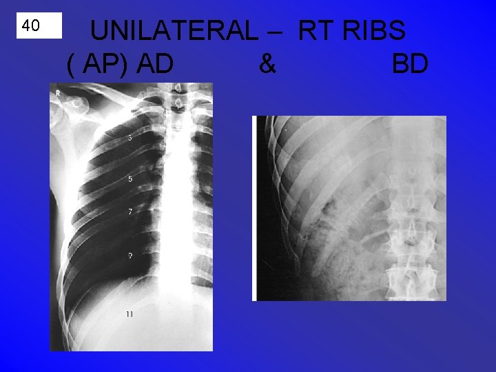 40 UNILATERAL – RT RIBS ( AP) AD & BD 