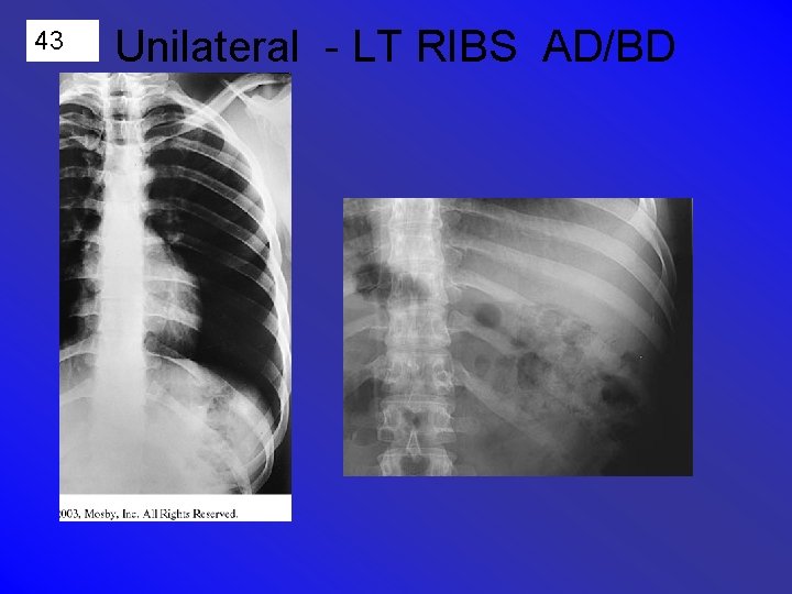 43 Unilateral - LT RIBS AD/BD 