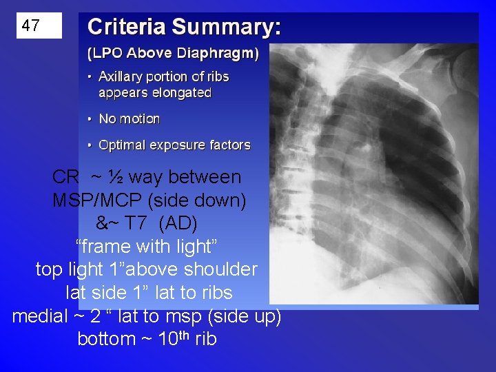 47 CR ~ ½ way between MSP/MCP (side down) &~ T 7 (AD) “frame