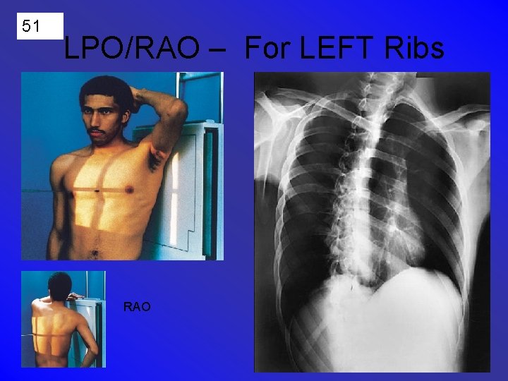 51 LPO/RAO – For LEFT Ribs RAO 