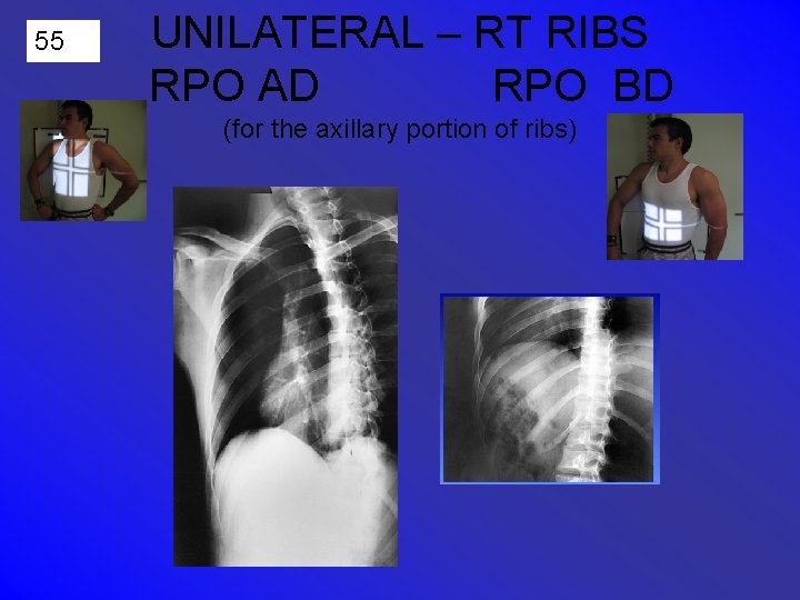 55 UNILATERAL – RT RIBS RPO AD RPO BD (for the axillary portion of