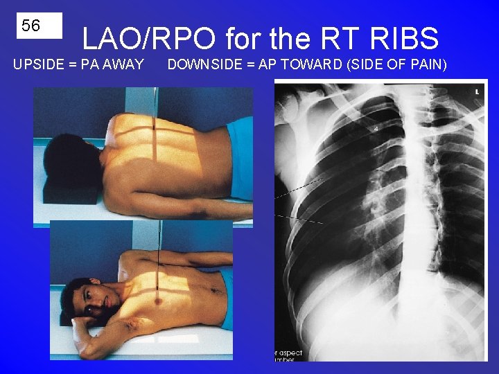 56 LAO/RPO for the RT RIBS UPSIDE = PA AWAY DOWNSIDE = AP TOWARD