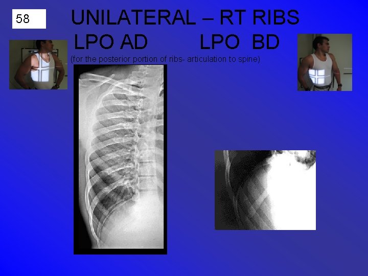 58 UNILATERAL – RT RIBS LPO AD LPO BD (for the posterior portion of