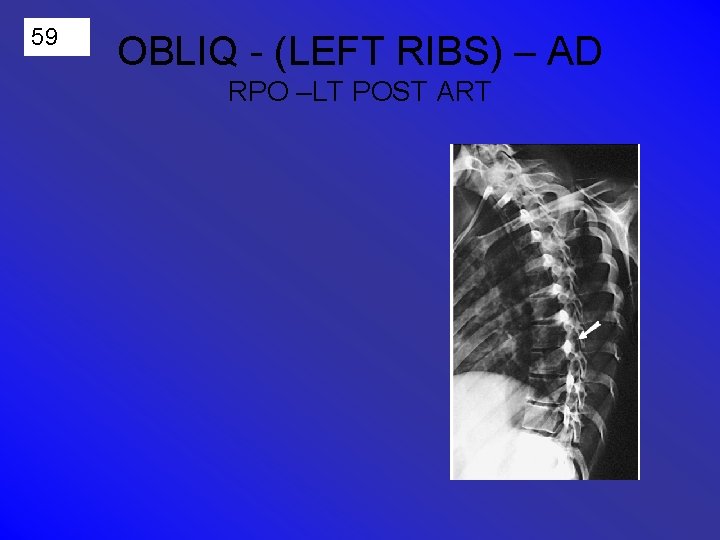 59 OBLIQ - (LEFT RIBS) – AD RPO –LT POST ART 