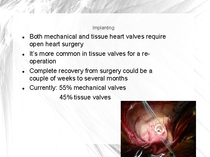 Implanting Both mechanical and tissue heart valves require open heart surgery It’s more common