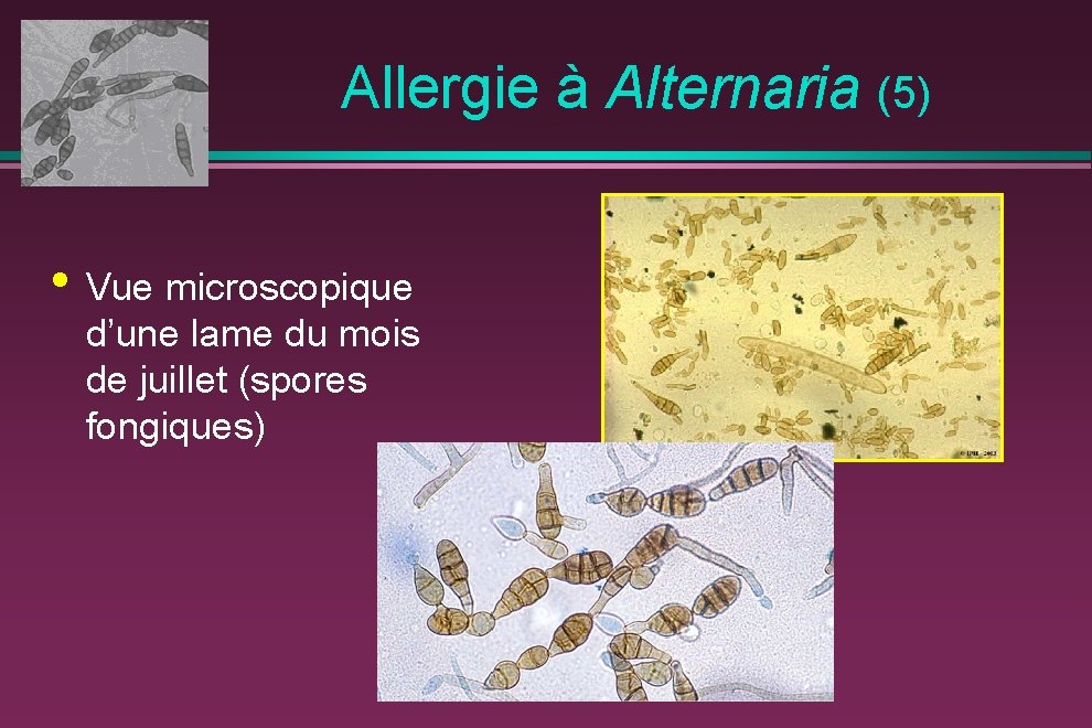  Allergie à Alternaria (5) • Vue microscopique d’une lame du mois de juillet