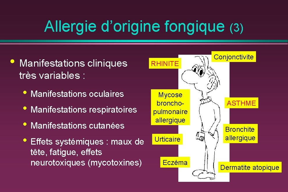 Allergie d’origine fongique (3) • Manifestations cliniques RHINITE Conjonctivite très variables : • Manifestations