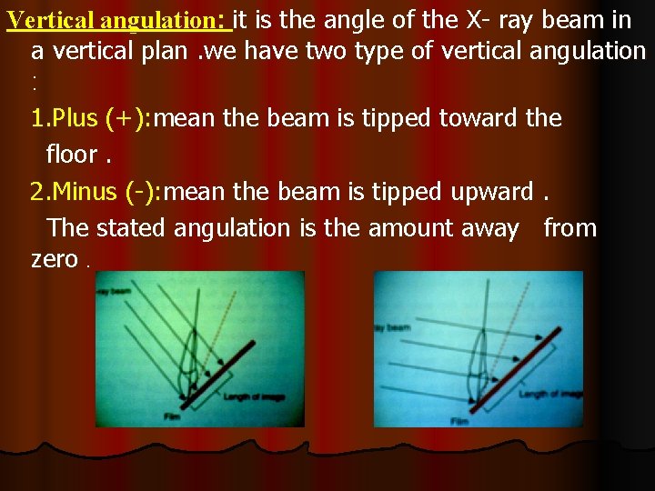 Vertical angulation: it is the angle of the X- ray beam in a vertical