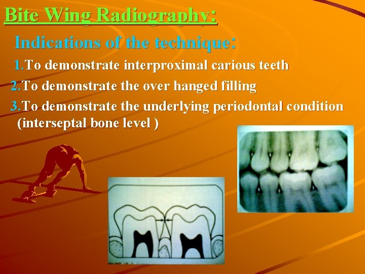 Bite Wing Radiography: Indications of the technique: 1. To demonstrate interproximal carious teeth 2.