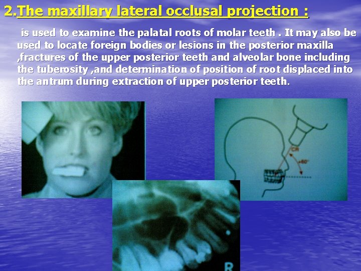 2. The maxillary lateral occlusal projection : is used to examine the palatal roots