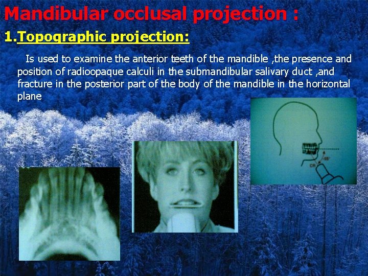 Mandibular occlusal projection : 1. Topographic projection: Is used to examine the anterior teeth