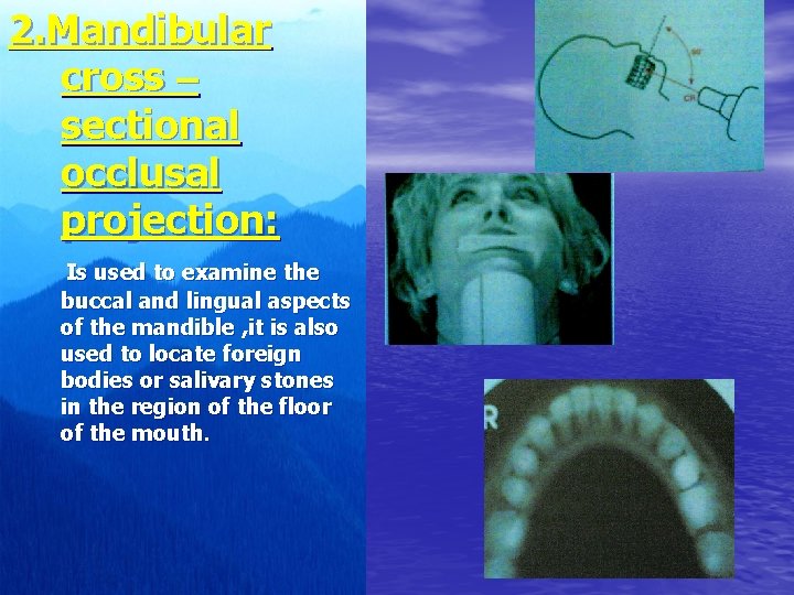 2. Mandibular cross – sectional occlusal projection: Is used to examine the buccal and