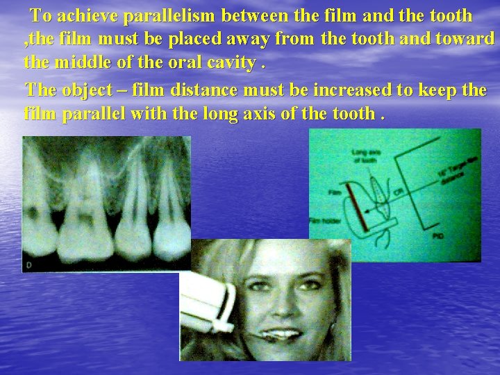 To achieve parallelism between the film and the tooth , the film must be