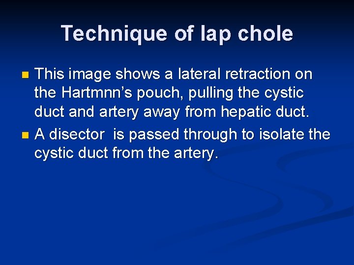 Technique of lap chole This image shows a lateral retraction on the Hartmnn’s pouch,