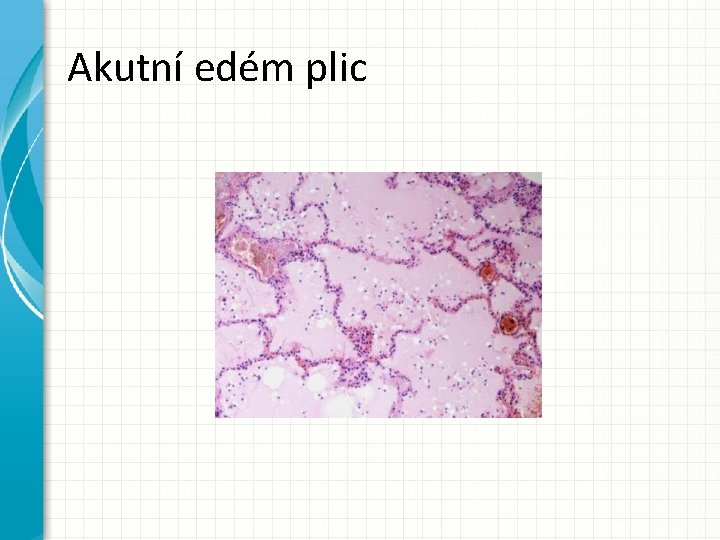 Akutní edém plic 