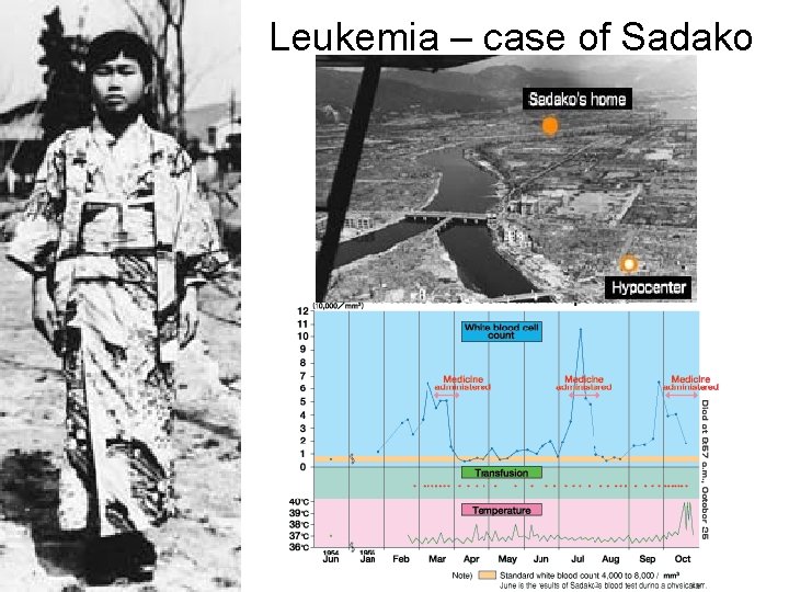 Leukemia – case of Sadako 