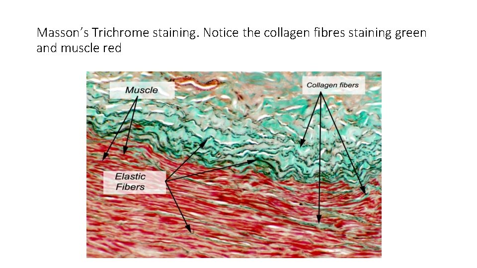 Masson’s Trichrome staining. Notice the collagen fibres staining green and muscle red 