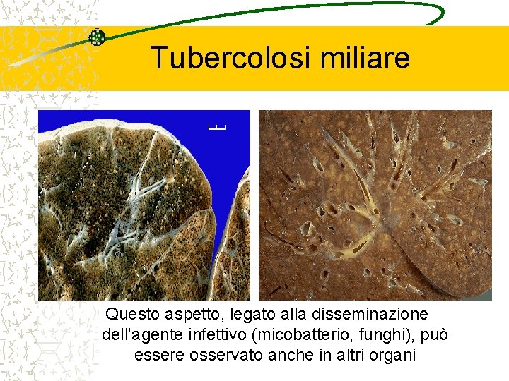 Tubercolosi miliare Questo aspetto, legato alla disseminazione dell’agente infettivo (micobatterio, funghi), può essere osservato