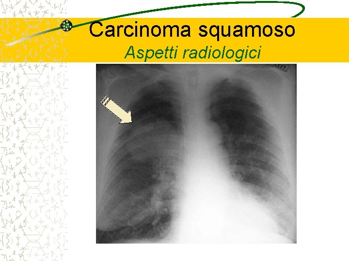 Carcinoma squamoso Aspetti radiologici 