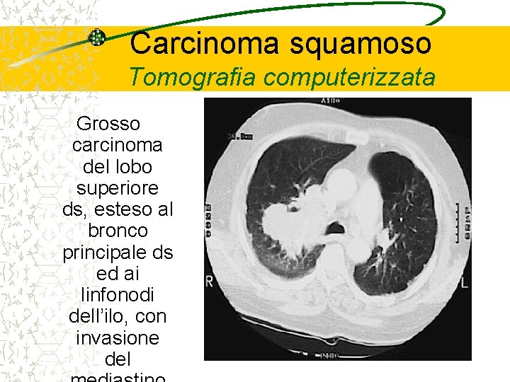 Carcinoma squamoso Tomografia computerizzata Grosso carcinoma del lobo superiore ds, esteso al bronco principale