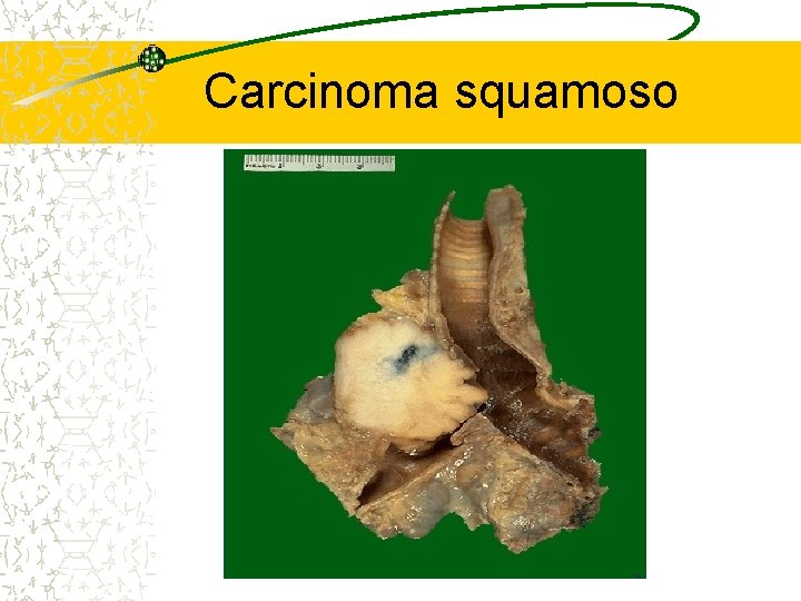 Carcinoma squamoso 