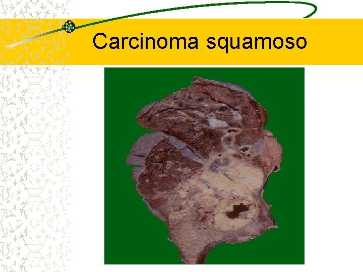 Carcinoma squamoso 