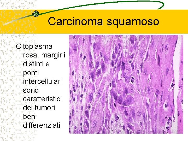 Carcinoma squamoso Citoplasma rosa, margini distinti e ponti intercellulari sono caratteristici dei tumori ben