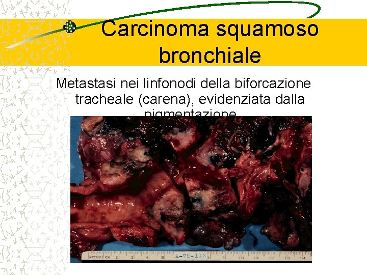 Carcinoma squamoso bronchiale Metastasi nei linfonodi della biforcazione tracheale (carena), evidenziata dalla pigmentazione 