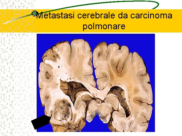 Metastasi cerebrale da carcinoma polmonare 