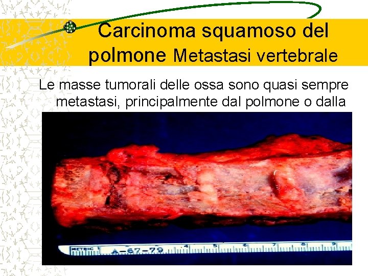 Carcinoma squamoso del polmone Metastasi vertebrale Le masse tumorali delle ossa sono quasi sempre