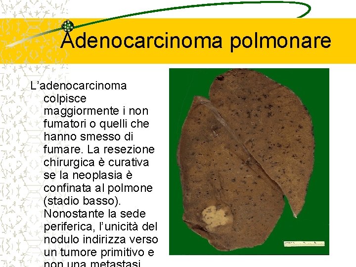 Adenocarcinoma polmonare L’adenocarcinoma colpisce maggiormente i non fumatori o quelli che hanno smesso di