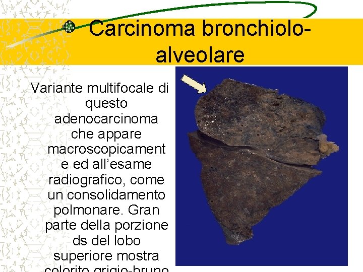 Carcinoma bronchioloalveolare Variante multifocale di questo adenocarcinoma che appare macroscopicament e ed all’esame radiografico,